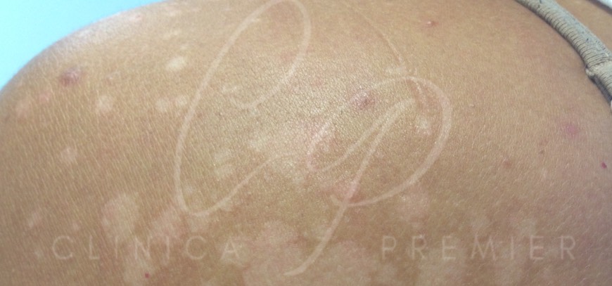 Pitiriasis versicolor-Dermatólogo Palma Dermatóloga Palma. Mallorca